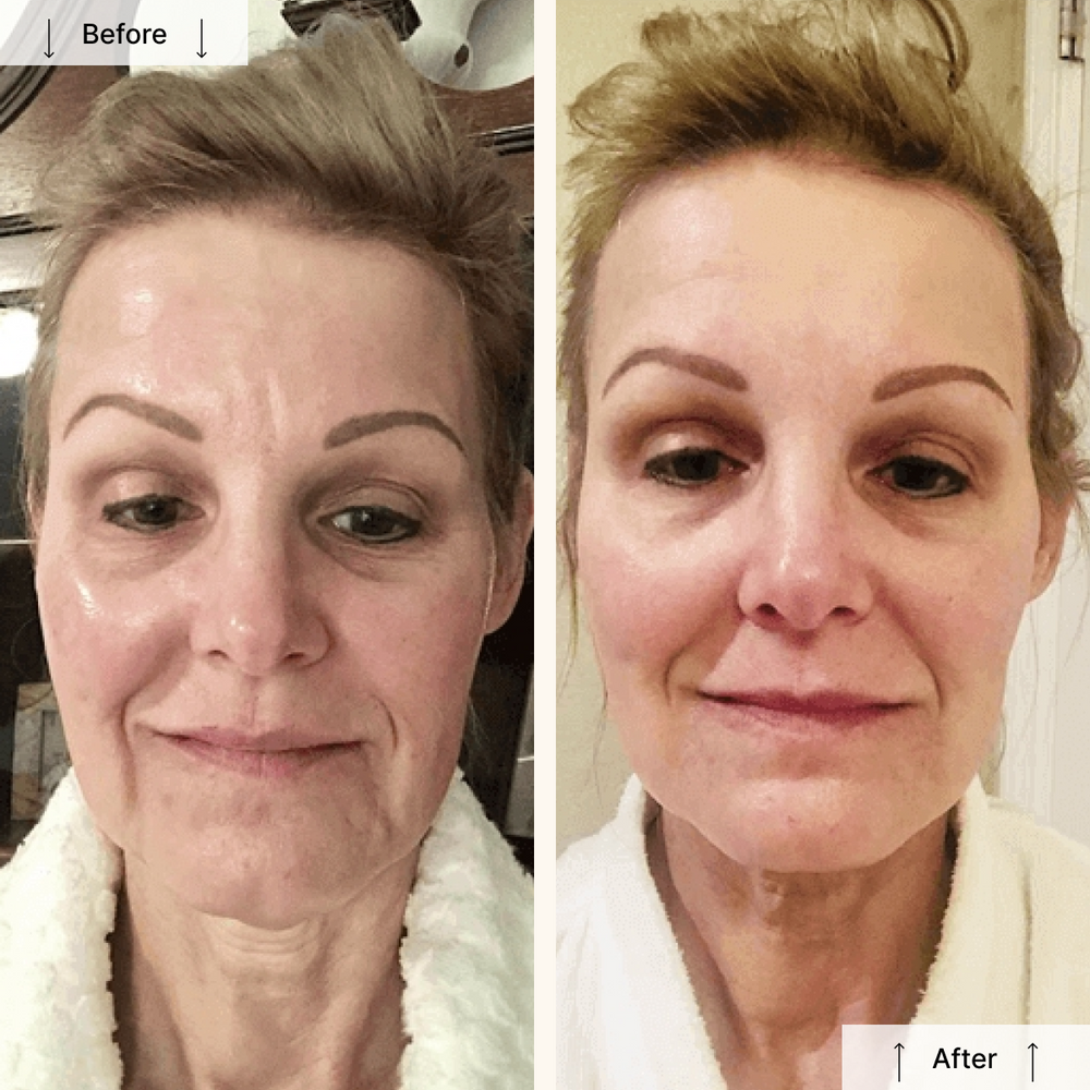 Nuovaluce LED Light Therapy Face Mask