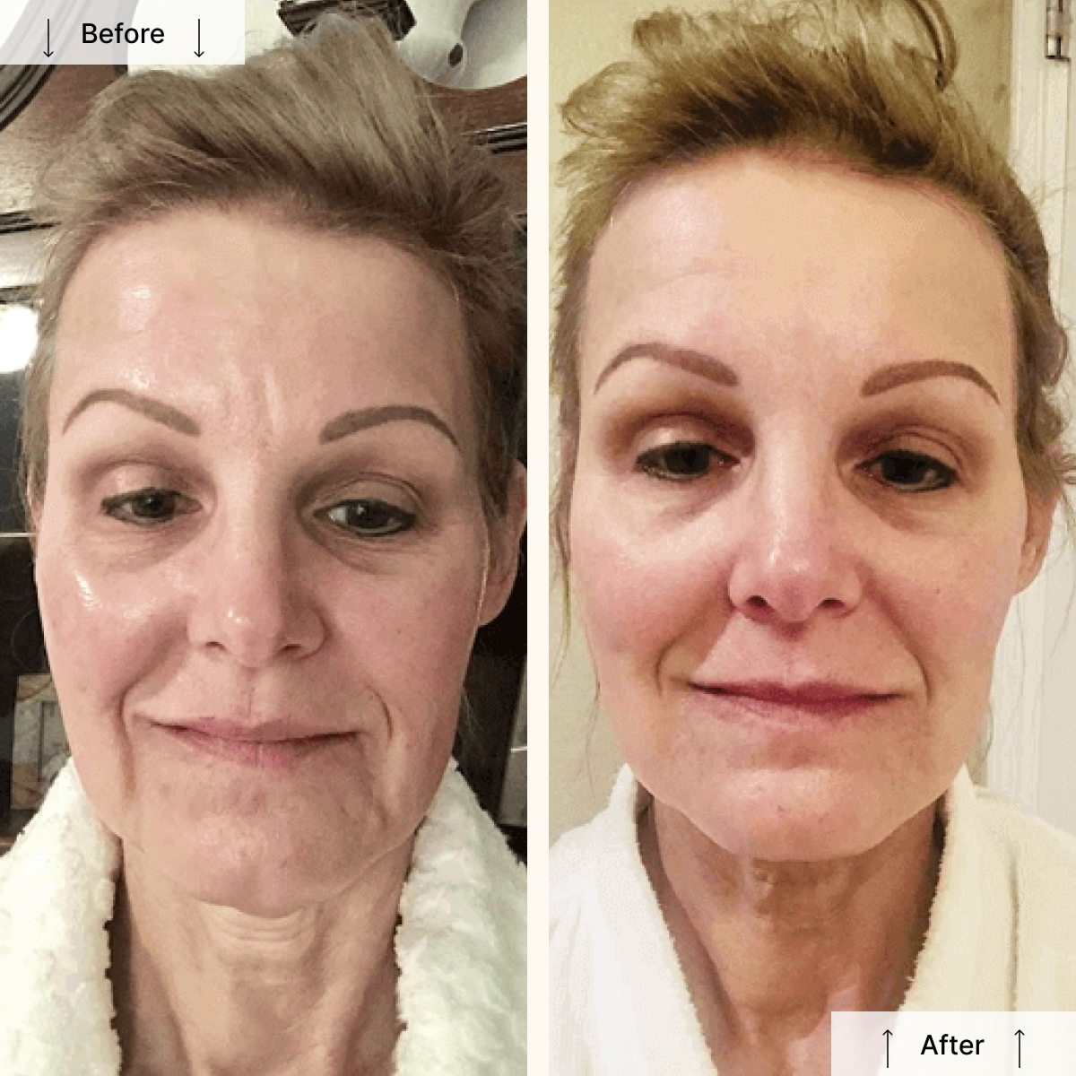 Nuovaluce LED Light Therapy Face Mask - Redirect