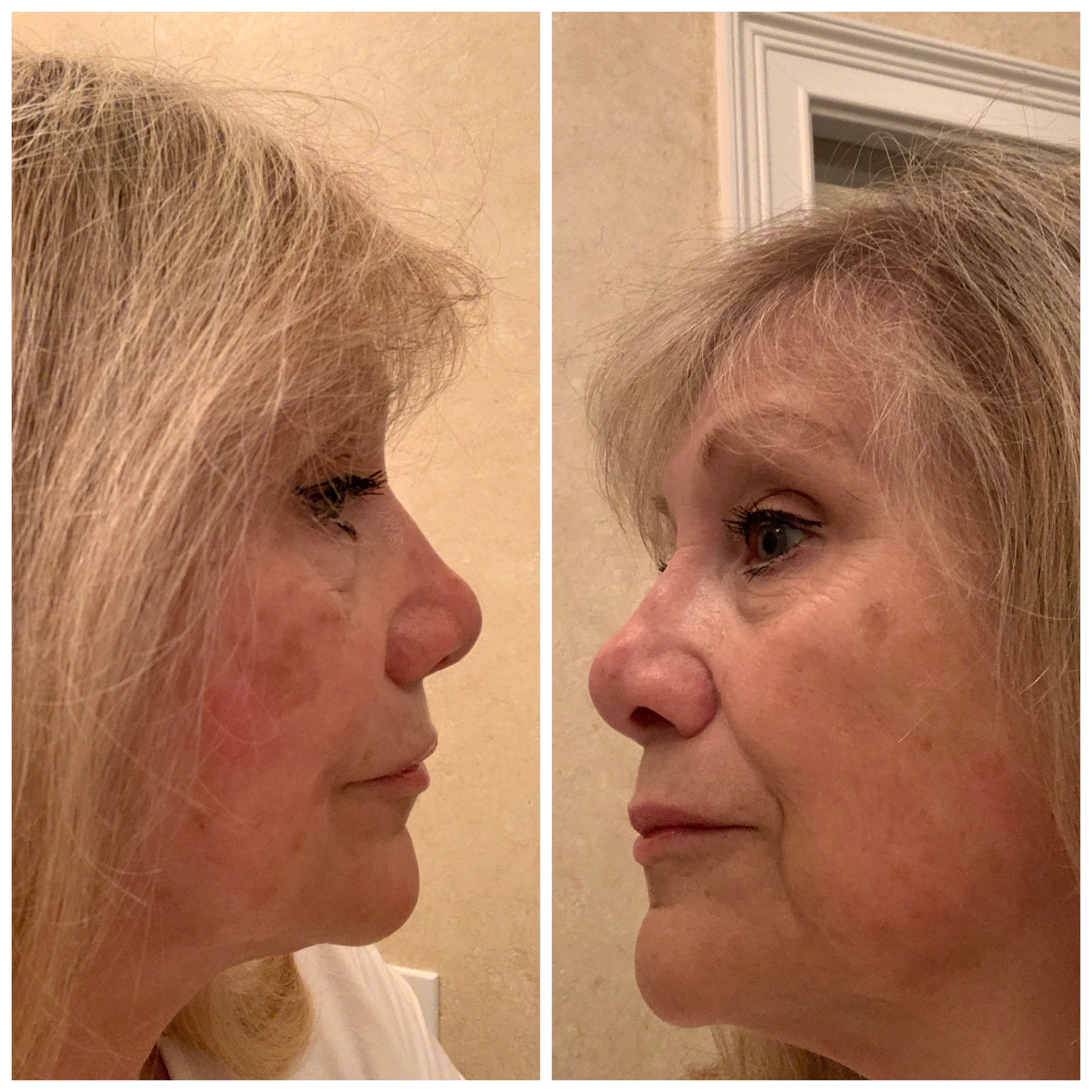Nuovaluce customer before and after result 35