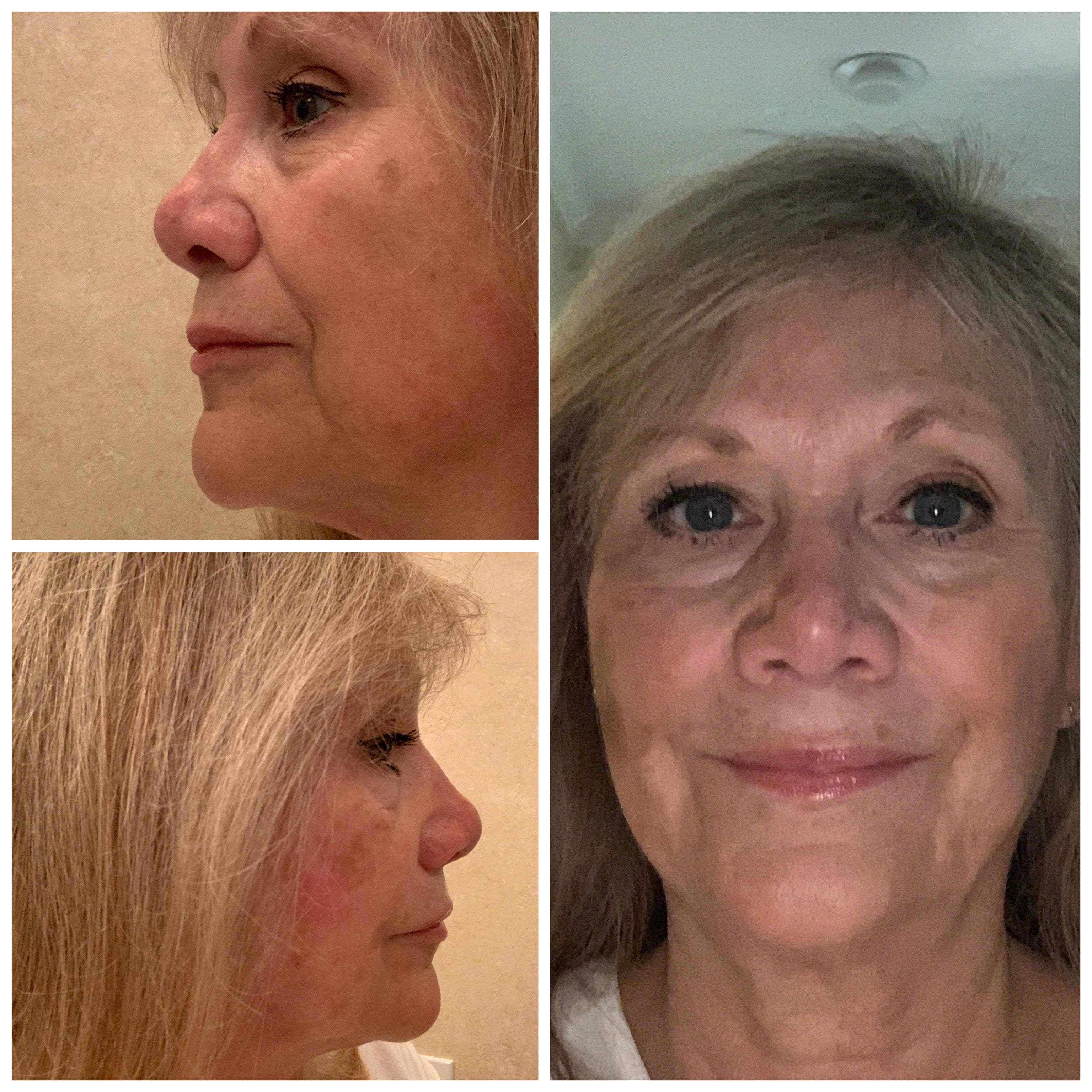 Nuovaluce customer before and after result 36