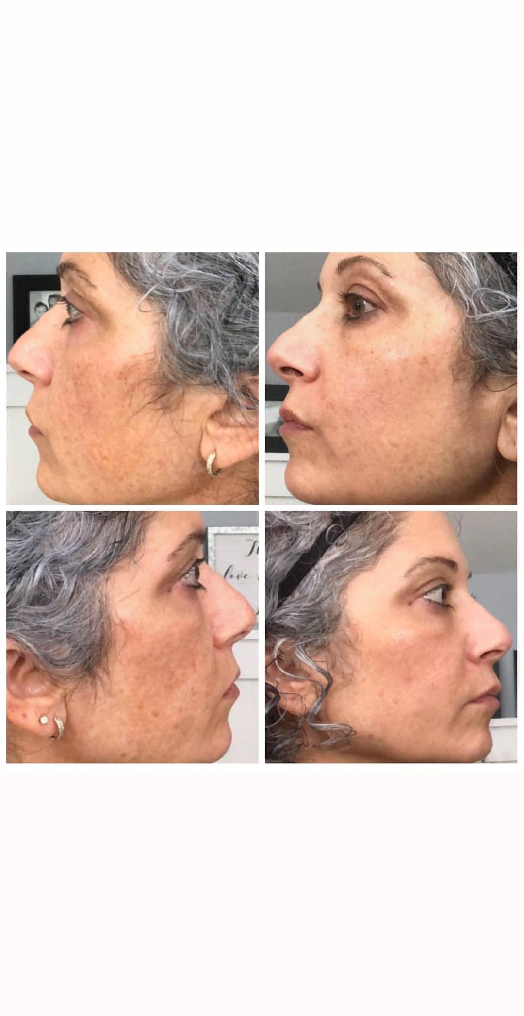 Nuovaluce customer before and after result 98