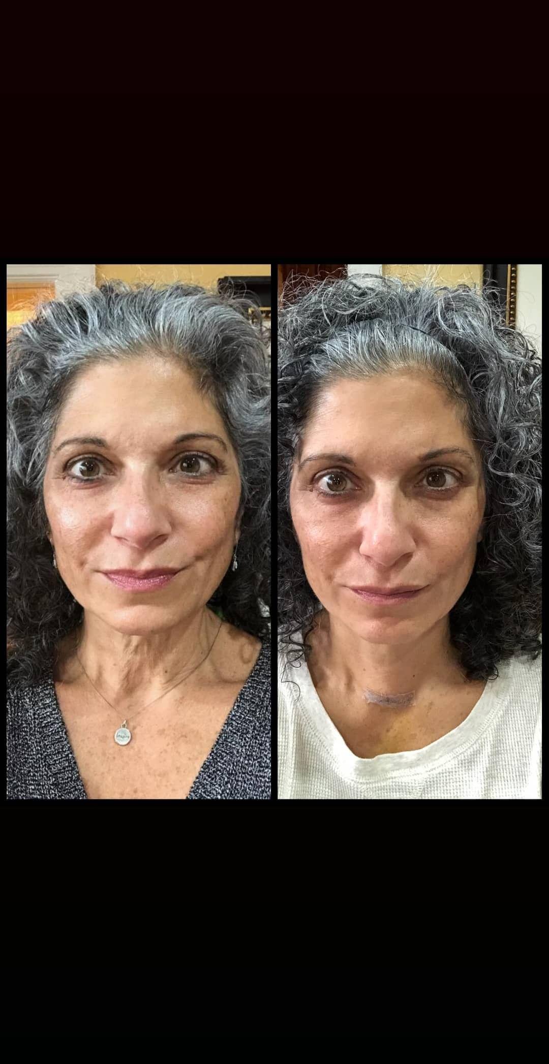 Nuovaluce customer before and after result 99