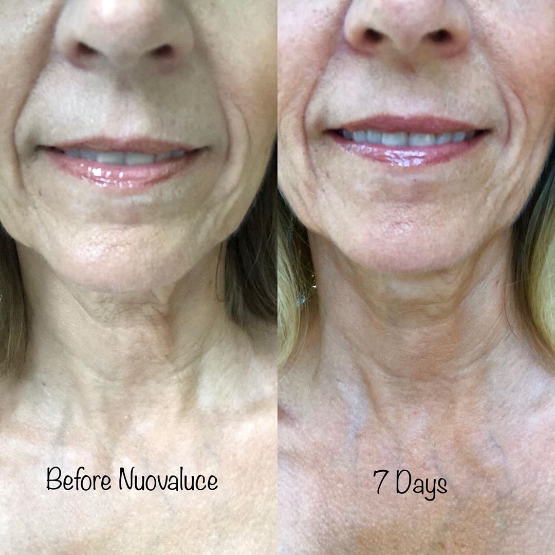 Nuovaluce customer before and after result 117