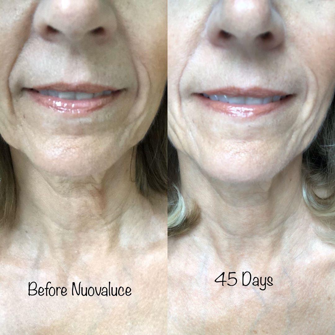 Nuovaluce customer before and after result 118