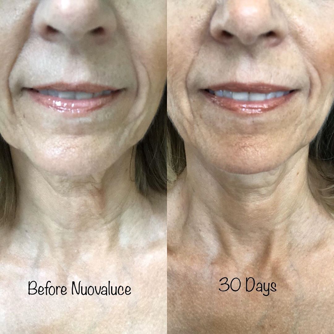 Nuovaluce customer before and after result 119