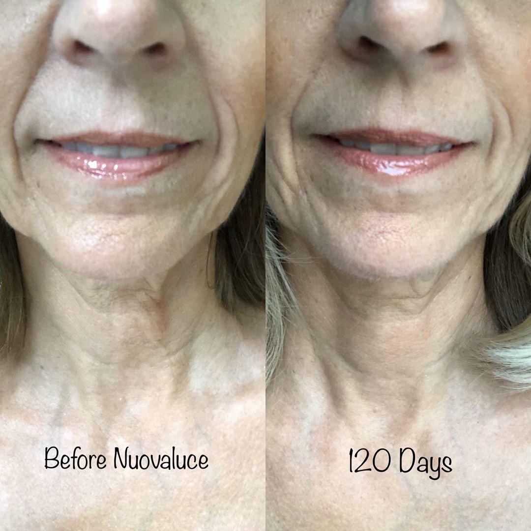 Nuovaluce customer before and after result 121