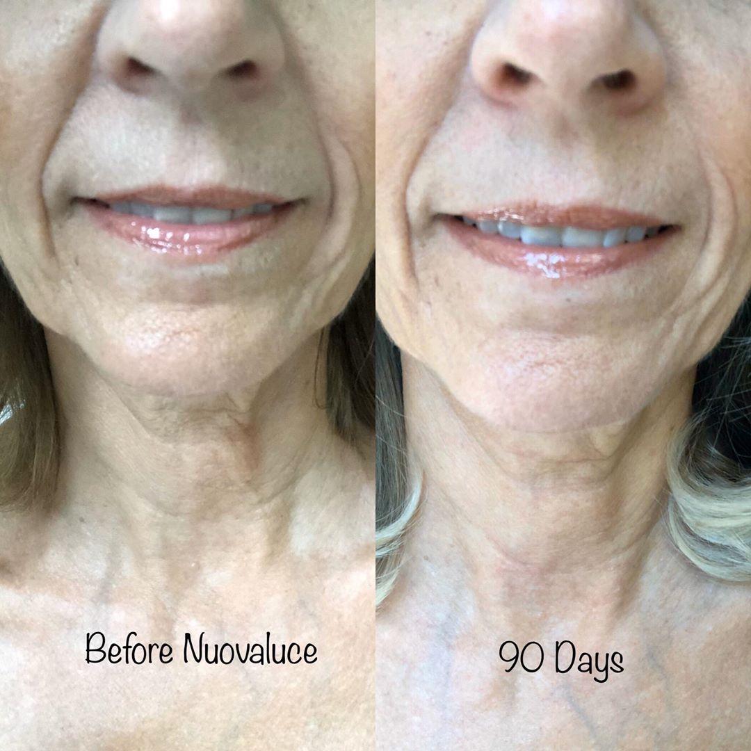 Nuovaluce customer before and after result 122