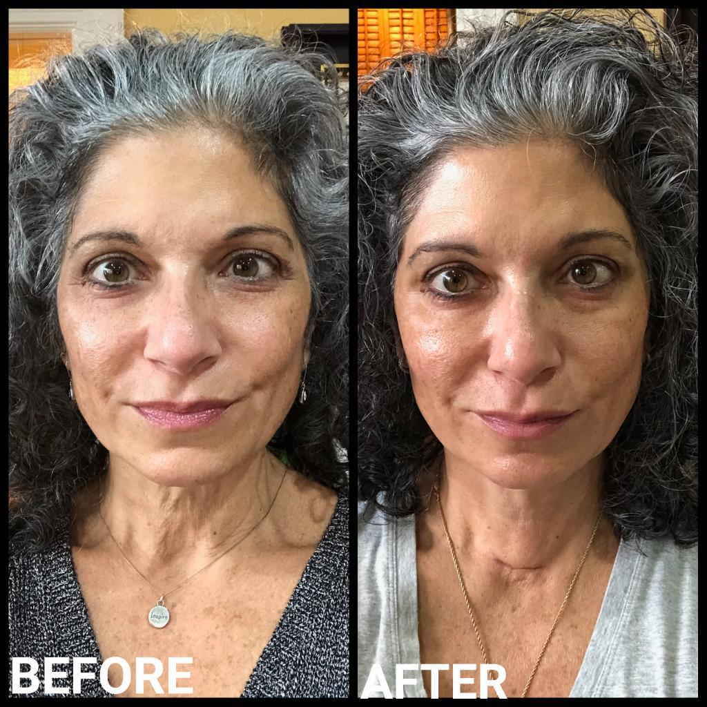 Nuovaluce customer before and after result 130
