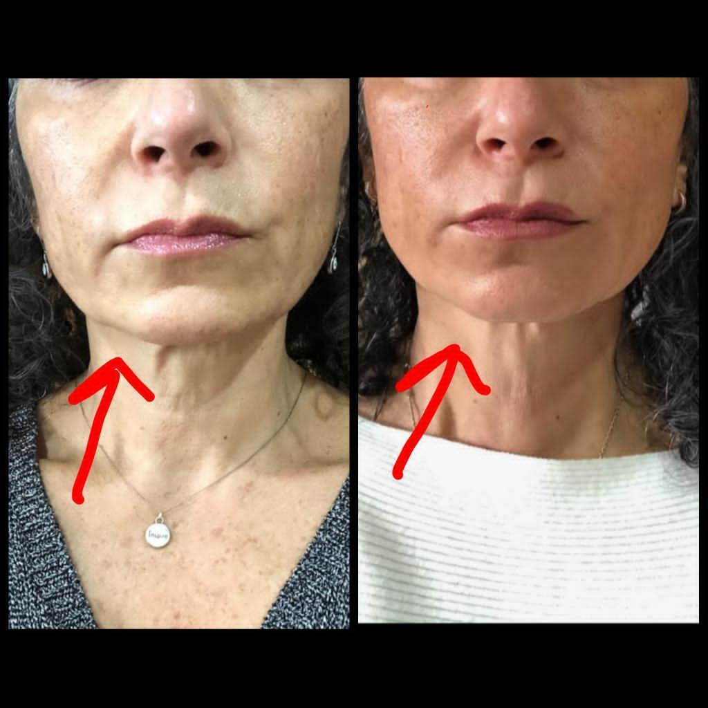 Nuovaluce customer before and after result 131