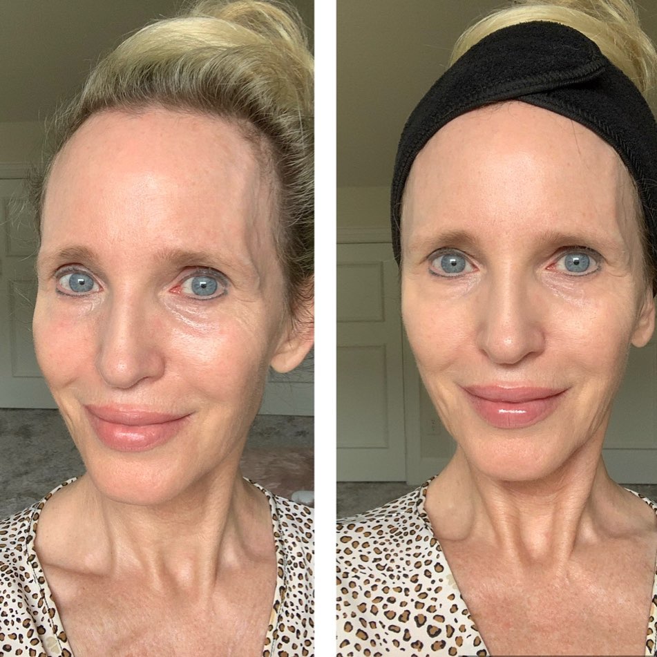 Nuovaluce customer before and after result 138