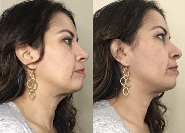 Nuovaluce customer before and after result 167