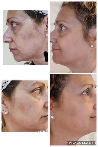 Nuovaluce customer before and after result 172