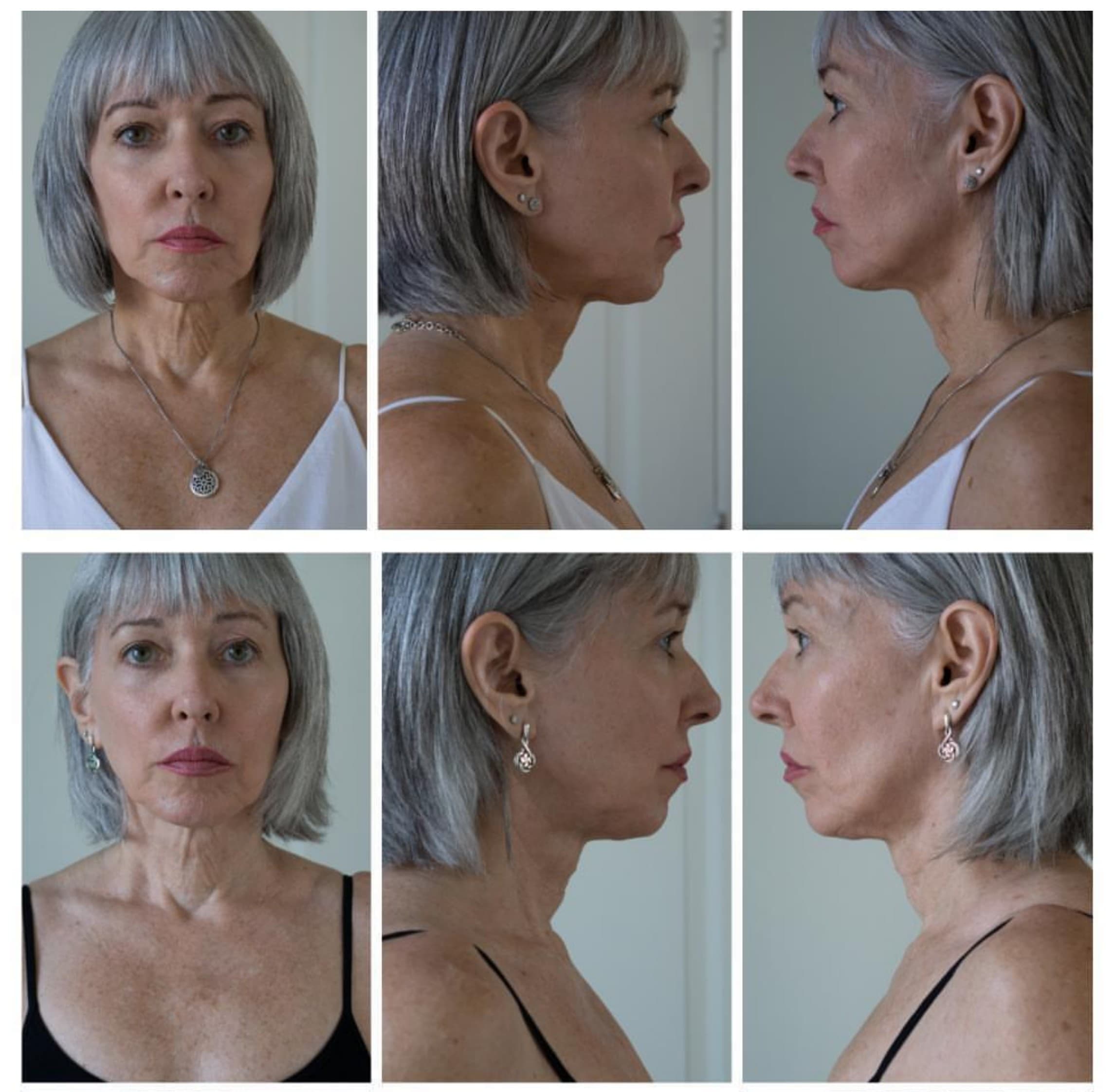 Nuovaluce customer before and after result 207