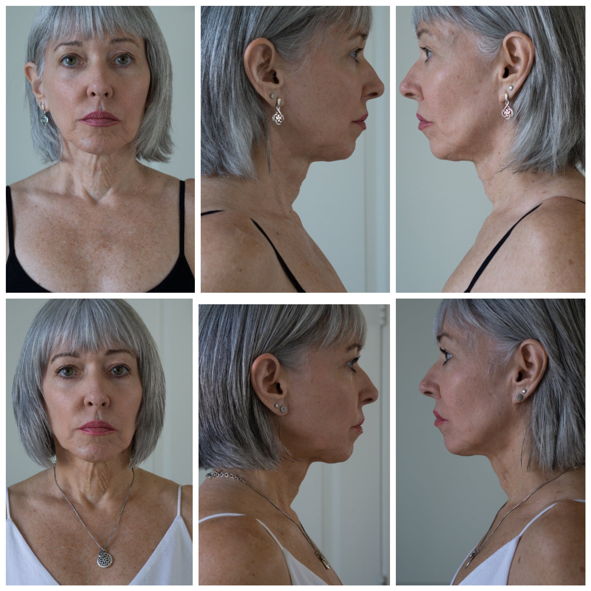Nuovaluce customer before and after result 213
