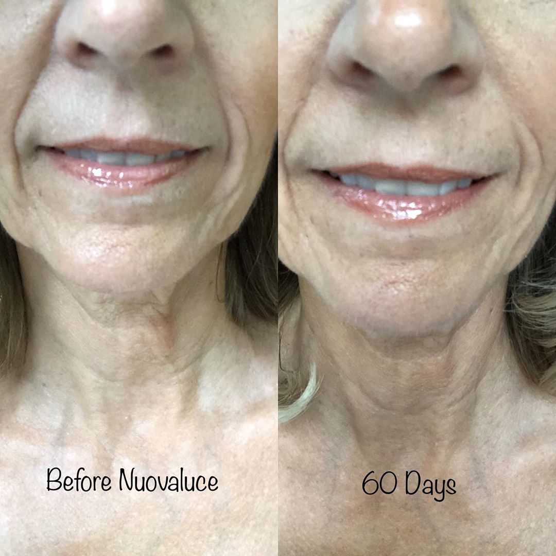 Nuovaluce customer before and after result 234