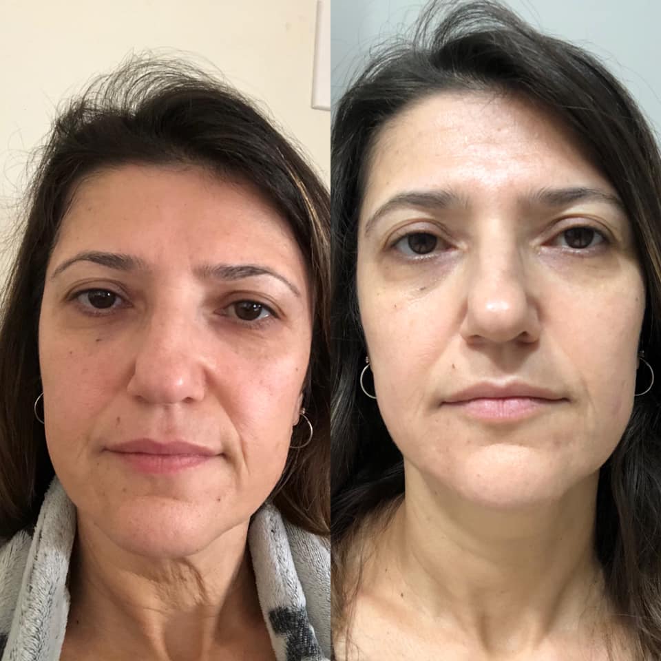 Nuovaluce customer before and after result 263